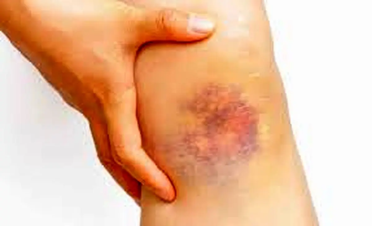 علت کبودی بدن بدون ضربه چیست؟