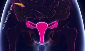 سرطان تخمدان و علایم هشدار دهنده ای که هر زنی باید بداند