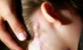 تورم گره‌های لنفاوی