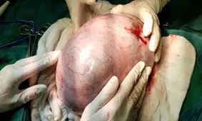 توده ۵ کیلویی از بدن یک زن سردشتی خارج شد + تصویر