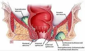 شناخت بیماری آبسه مقعد و درمان آن