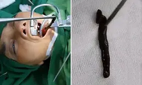 بیرون کشیدن زالوی خون آشام از گلوی زن ویتنامی + فیلم