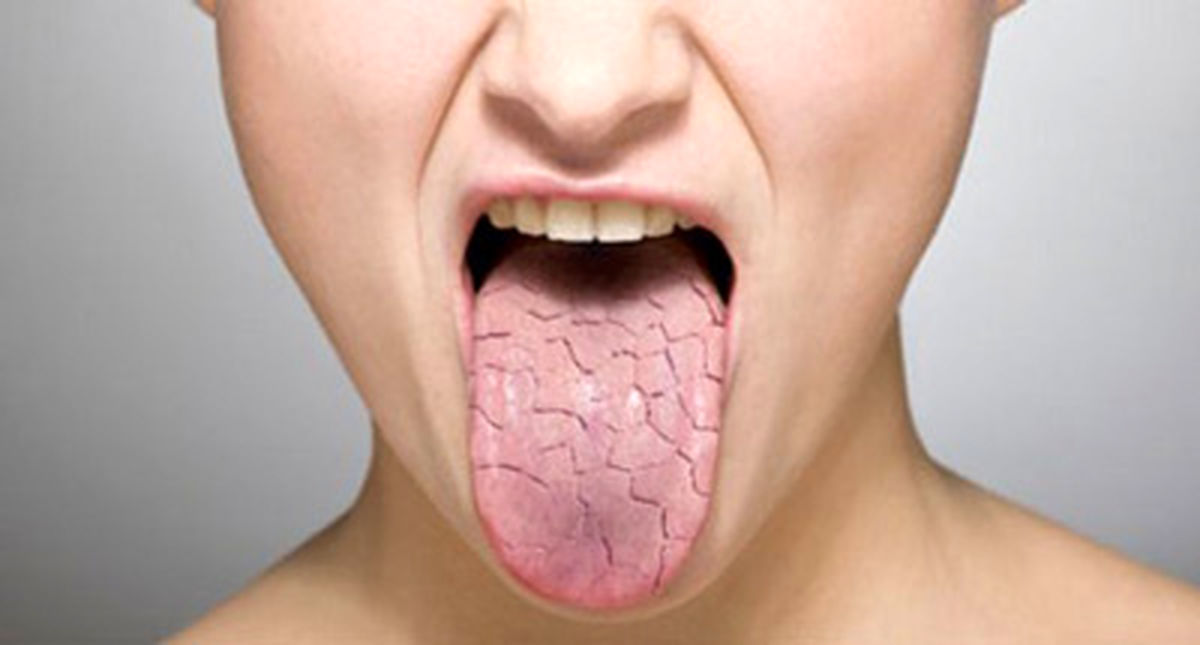 طب سنتی در مورد خشکی دهان چه می‌گوید؟