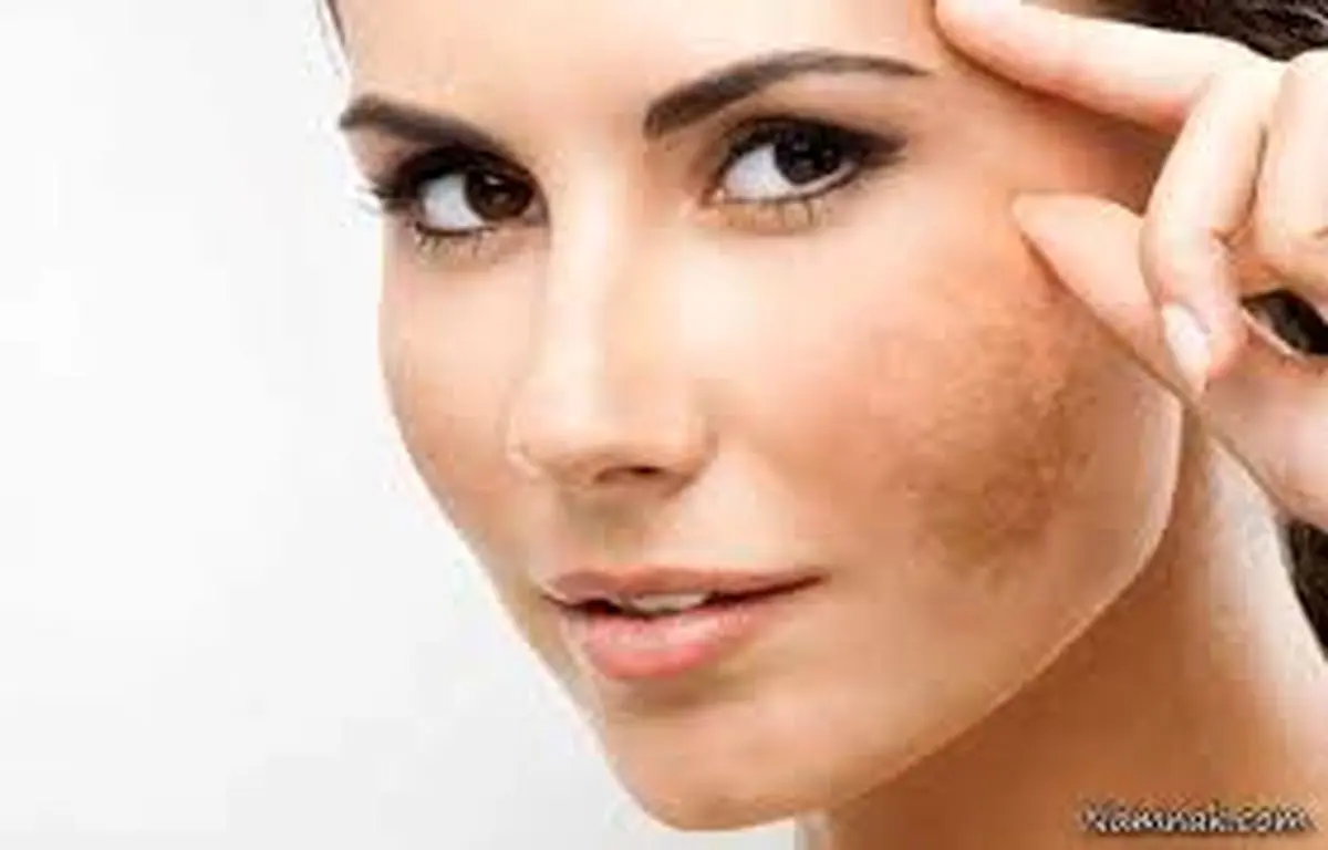درمان لکه صورت با ساده ترین روش ها