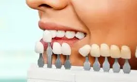 لمینت دندان چیست و چه تفاوتی با ایمپلنت دارد؟