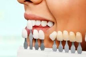 لمینت دندان چیست و چه تفاوتی با ایمپلنت دارد؟
