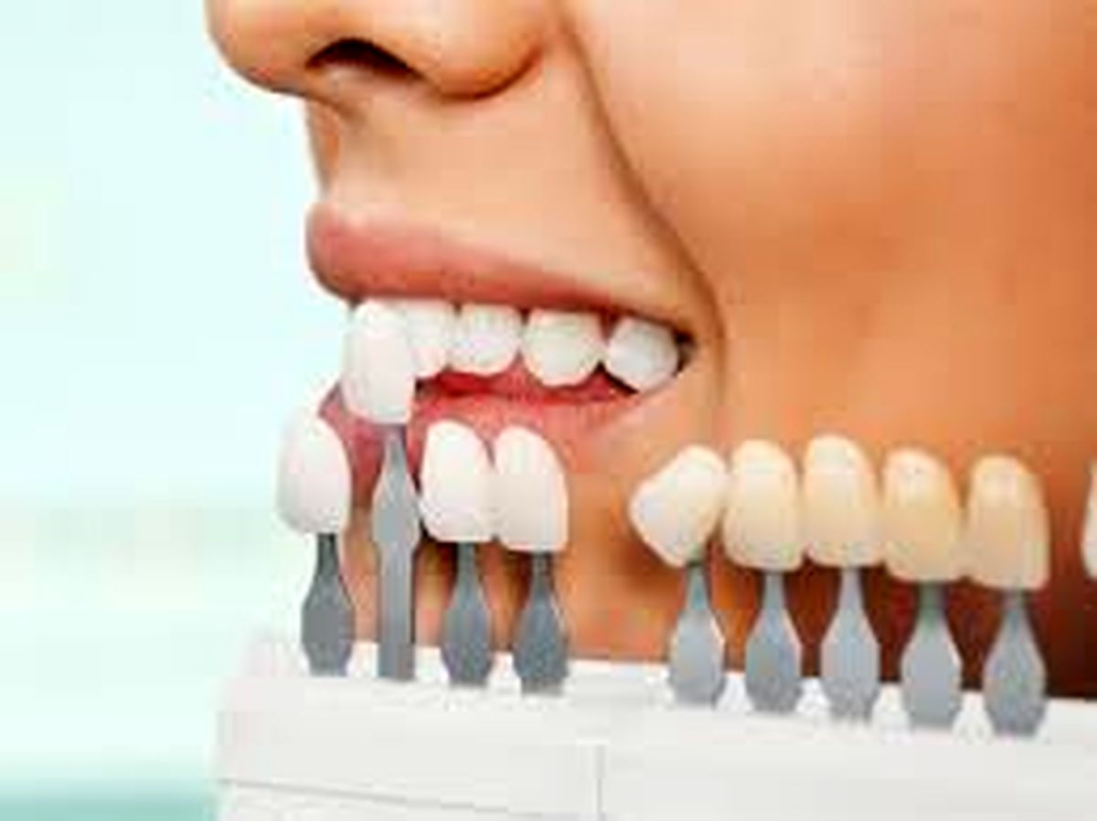 لمینت دندان چیست و چه تفاوتی با ایمپلنت دارد؟