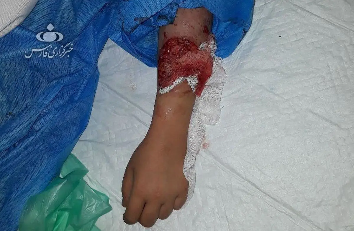 جزییات حادثه وحشتناک حمله دو سگ به دختر ۱۰ ساله در لواسان