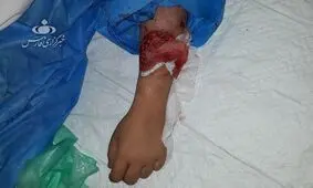 جزییات حادثه وحشتناک حمله دو سگ به دختر ۱۰ ساله در لواسان