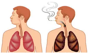 آمفیزم / بیماری مزمن ریوی