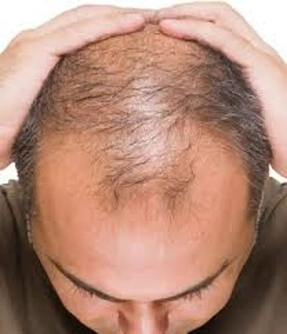 چگونه از ریزش مو پیشگیری کنم؟
