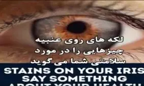 لکه‌های روی عنبیه چشم ، چه چیزی درمورد سلامتتان میگوید ؟