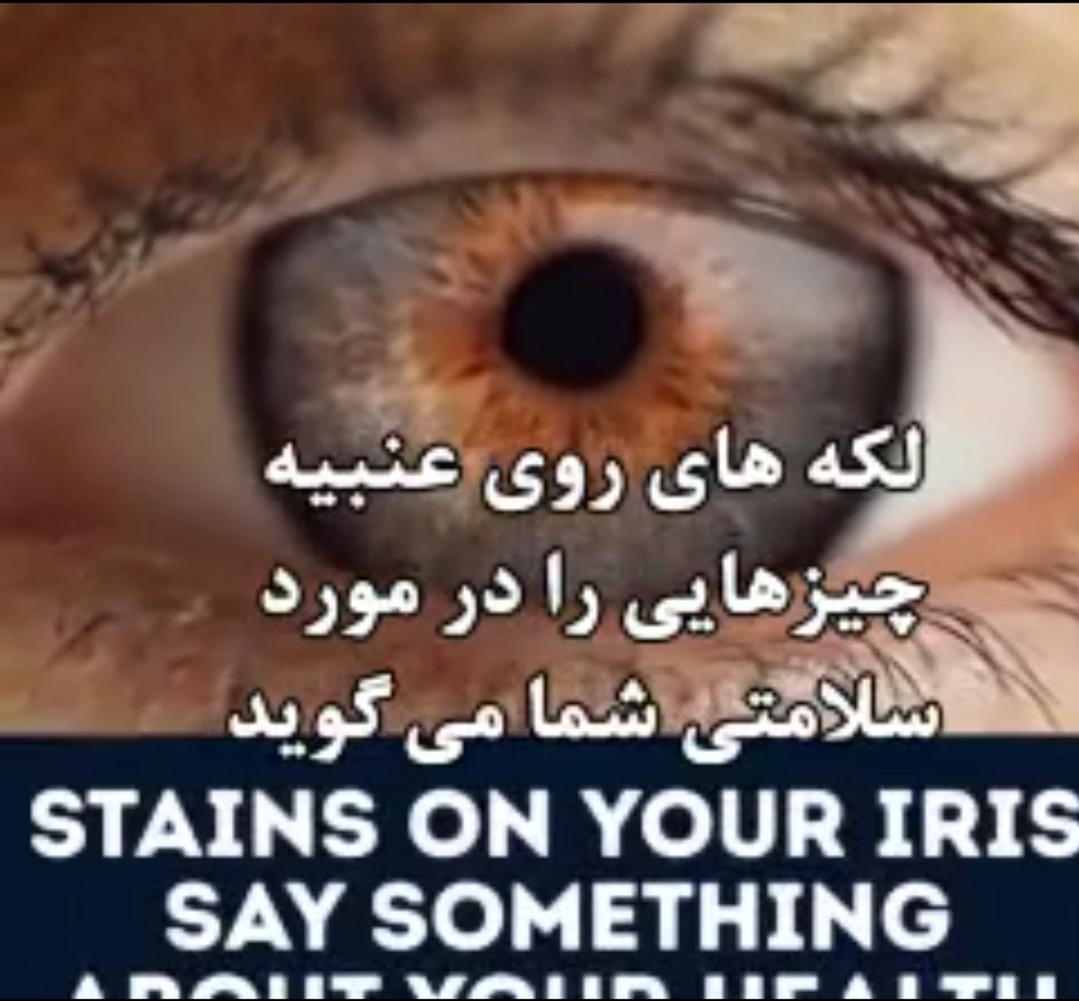 لکههای روی عنبیه چشم ، چه چیزی درمورد سلامتتان میگوید ؟