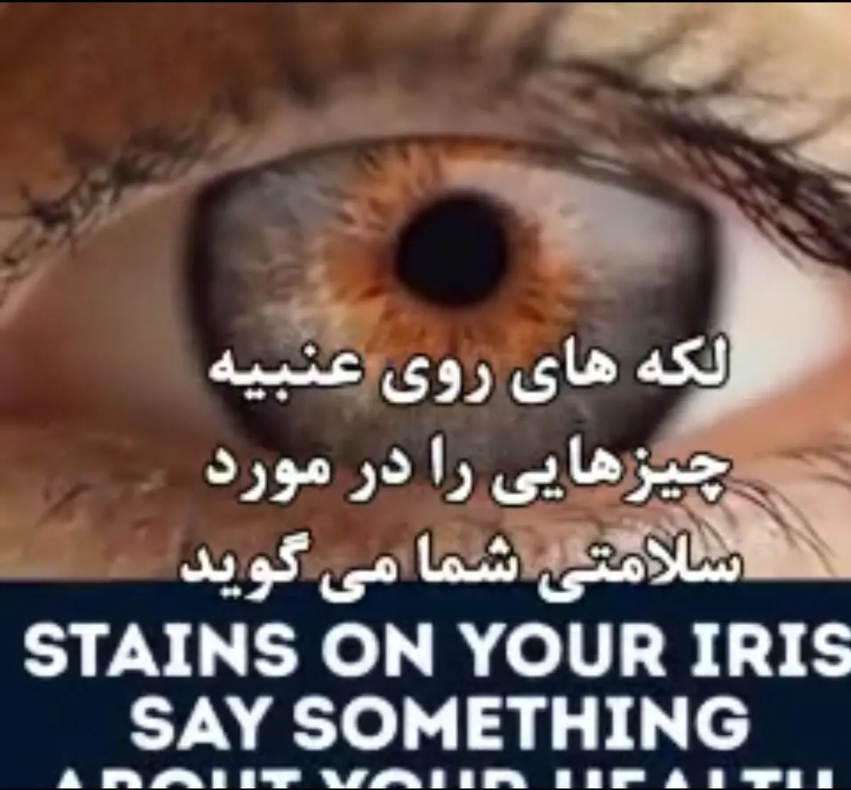 لکه‌های روی عنبیه چشم ، چه چیزی درمورد سلامتتان میگوید ؟