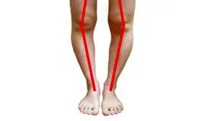 پای پرانتزی را با ورزش درمان کنید