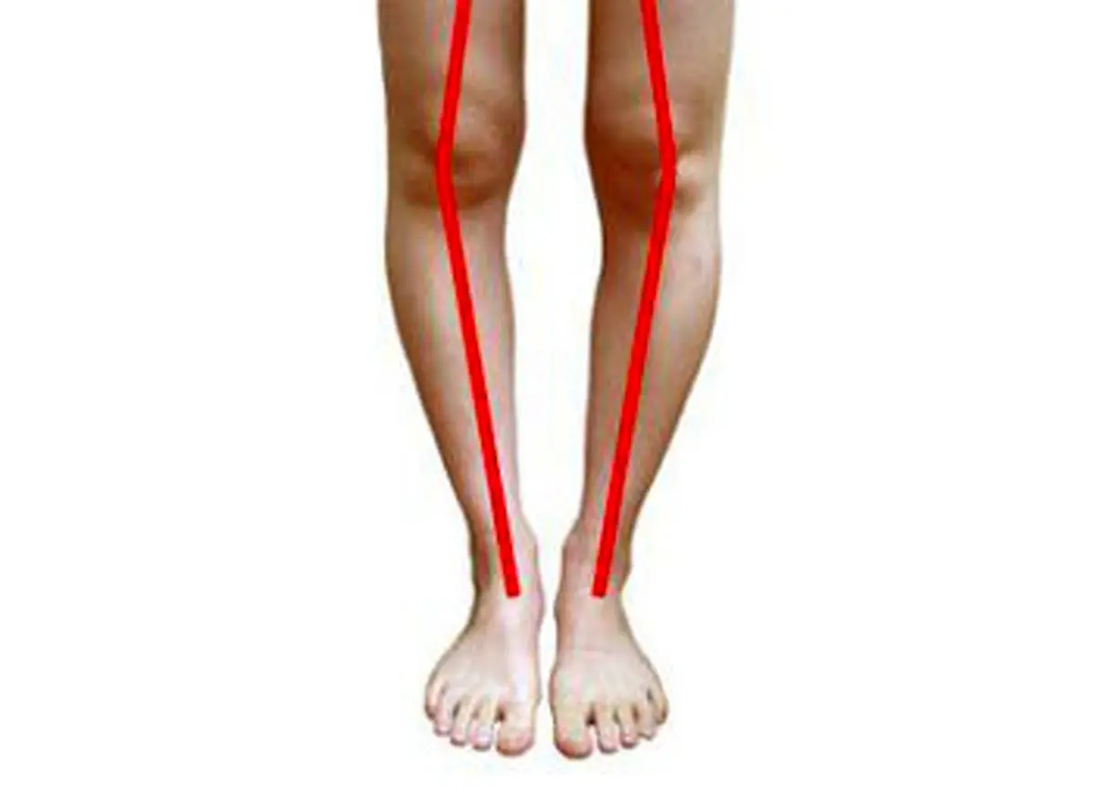 پای پرانتزی را با ورزش درمان کنید