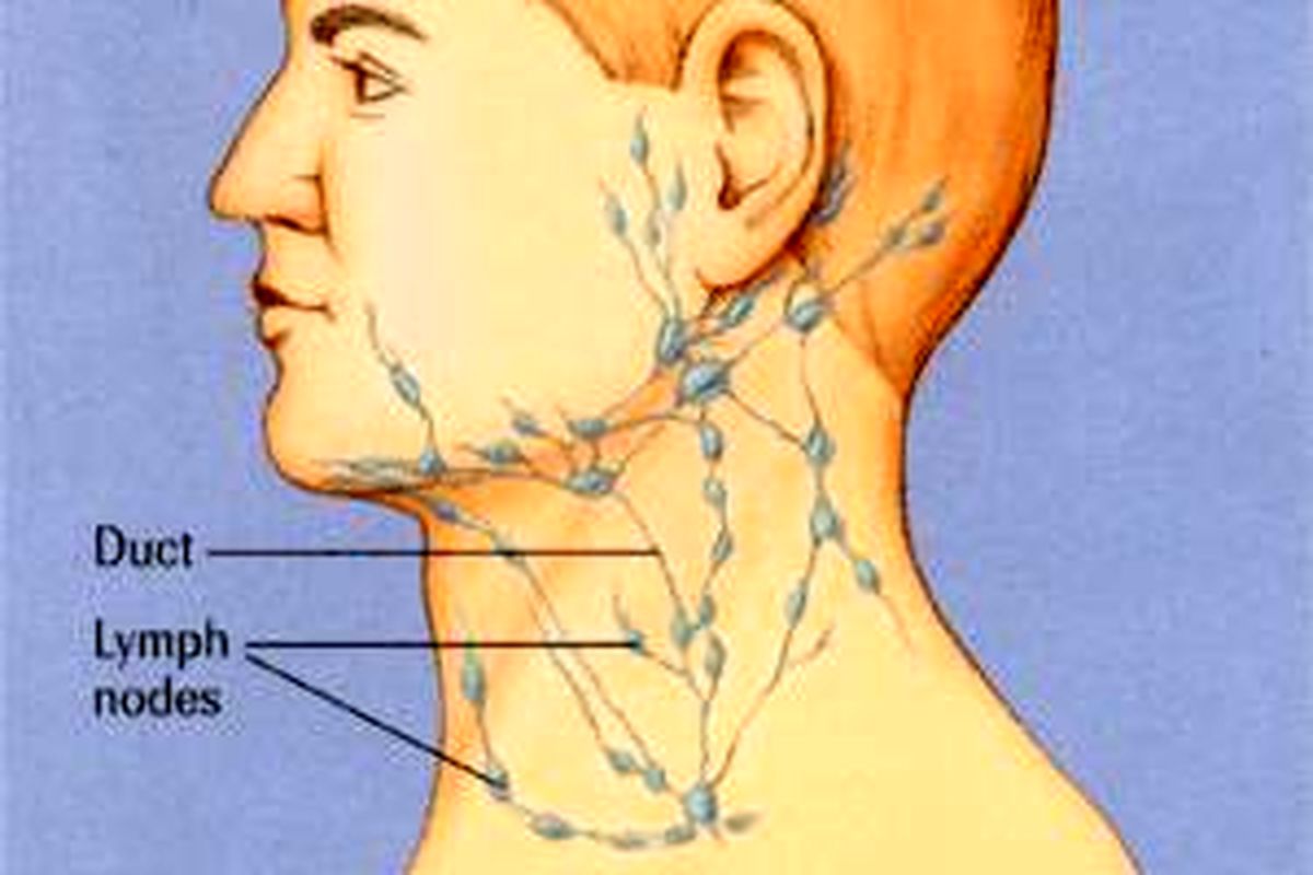 علت تورم غدد لنفاوی گردن و درمان آن