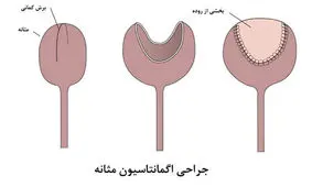 سندرم مثانه دردناک یا سیستیت بینابینی چیست؟