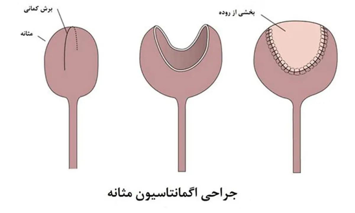سندرم مثانه دردناک یا سیستیت بینابینی چیست؟