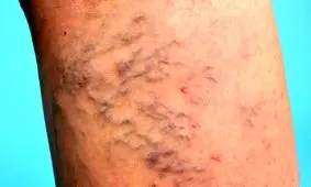 با روش‌های خانگی و تخصصی درمان واریس آشنا شوید