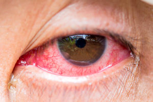 همه چیز در مورد آلرژی چشم