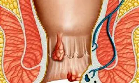 علایم بواسیر