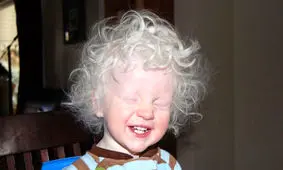 آلبینیسم؛ بیماری ژنتیکی افسانه‌ای