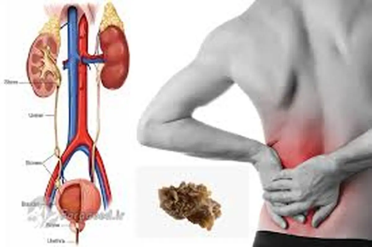 سنگ مثانه به چه دلایلی تشکیل می شود؟