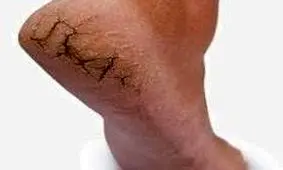 درمان ترک پا با فوت و فن های طبیعی و خانگی