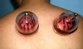 حجامت برای چه کسانی ممنوع است؟