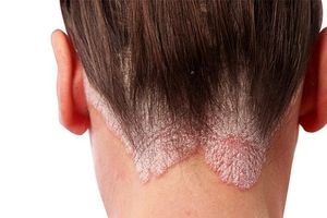 پسوریازیس پوست سر چیست؟ + علت، علائم و راه های درمان