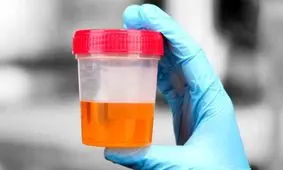 ادرار بد بو نشانه چیست؟