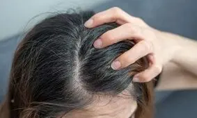 اگزمای پوست سر چیست و چطور درمان می‌شود؟