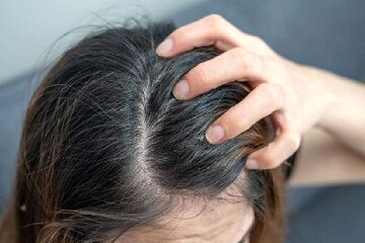 اگزمای پوست سر چیست و چطور درمان میشود؟