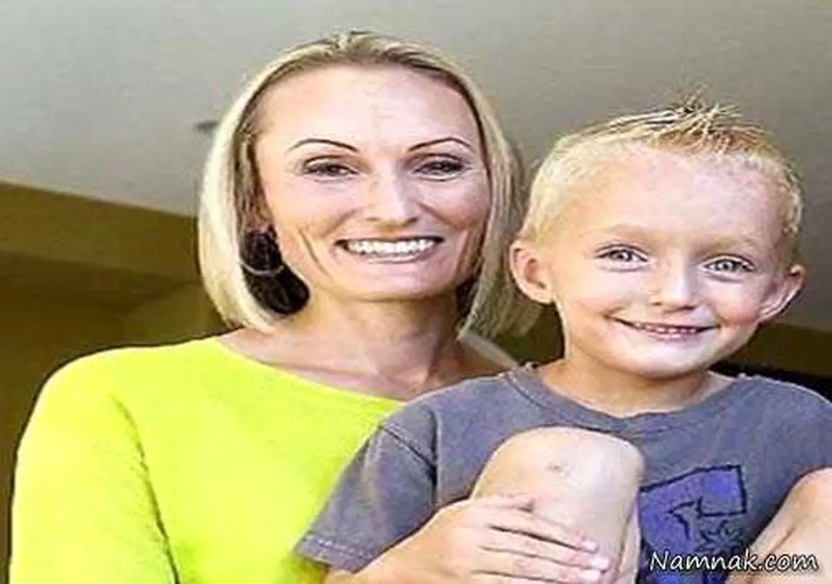 حلزون زنده زیر پوست یک پسر بچه + تصاویر