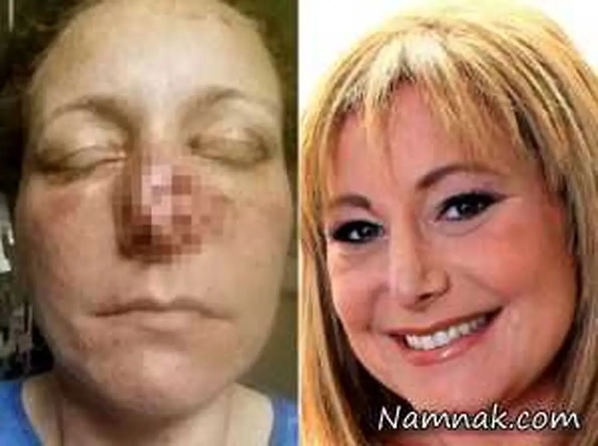 کنده شدن بینی زن جوان با دندان های نامزدش + تصاویر