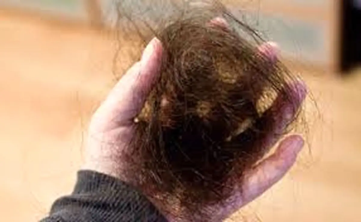 ۶ راه درمان خانگی ریزش شدید موی سر