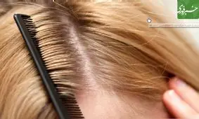 فرار از چربی و شوره موی سر با ساده ترین روش ها