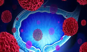 نشانه ابتلا به کشنده ترین سرطان زنانه