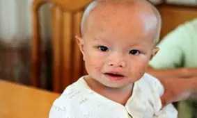 آب آوردن مغز یا هیدروسفالی؛ علت، علائم و راه‌های درمان