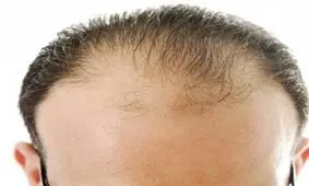 جلوگیری از ریزش مو
