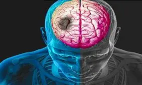 روش نوین درمان بیماران سکته مغزی در ایران