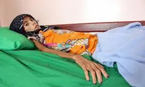 دختر ۱۲ ساله با ۱۰ کیلوگرم وزن بستری شد+ تصاویر