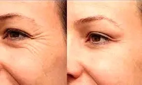 ترفندهای نابودی چین و چروک های دور چشم