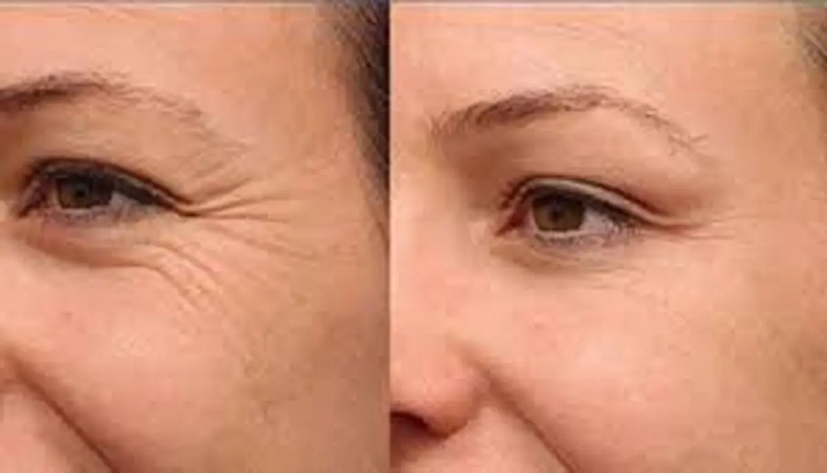 ترفندهای نابودی چین و چروک های دور چشم