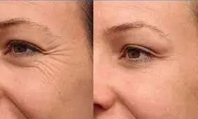ترفندهای نابودی چین و چروک های دور چشم