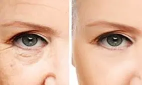 جلوگیری از چین و چروک دور چشم با مواد طبیعی
