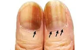 خطوط مشکی روی ناخن نشانه چه بیماری هایی است؟