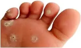 رفع پینه پا با ترفندهای خانگی