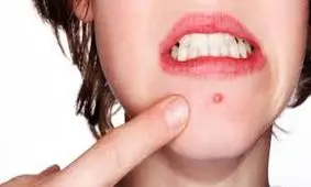 درمان های خانگی و طبیعی برای رفع جوش چانه